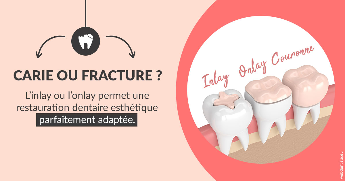 https://selarl-choblet.chirurgiens-dentistes.fr/T2 2023 - Carie ou fracture 2