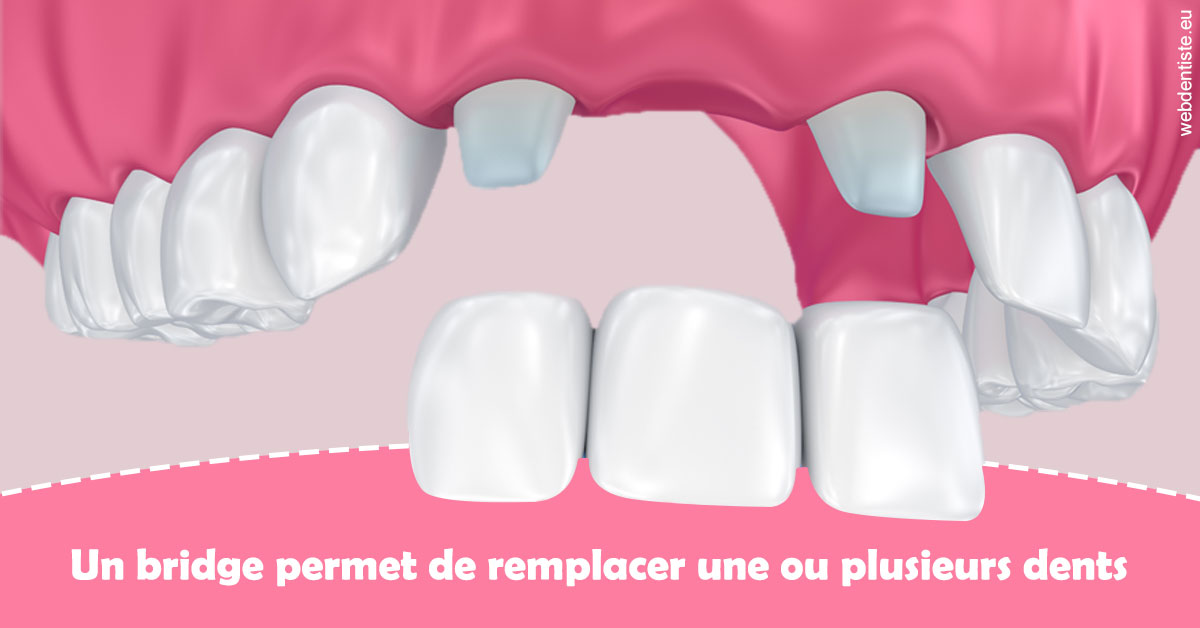 https://selarl-choblet.chirurgiens-dentistes.fr/Bridge remplacer dents 2