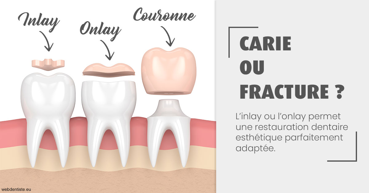 https://selarl-choblet.chirurgiens-dentistes.fr/T2 2023 - Carie ou fracture 1