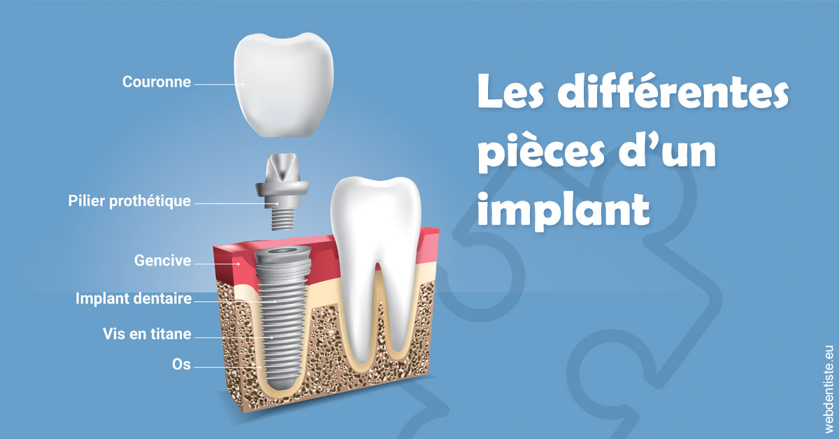 https://selarl-choblet.chirurgiens-dentistes.fr/Les différentes pièces d’un implant 1